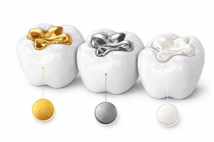 Schaubild mit verschiedenen Zahngoldfarben in Zähnen zur Einschätzung von Materialien und Wertmöglichkeiten beim Zahngoldankauf