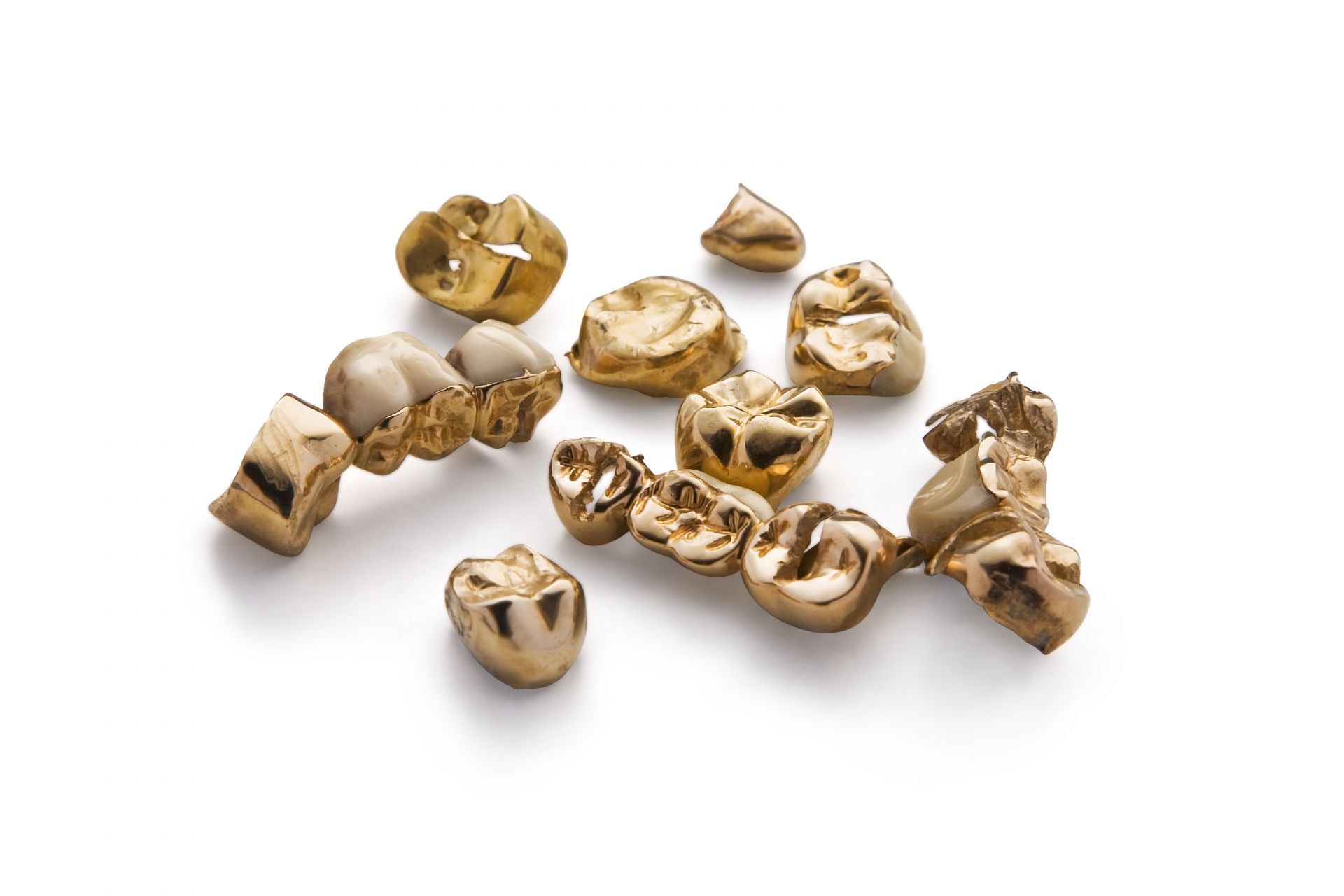 Goldkrone als Beispiel für den Ankauf von Zahngold